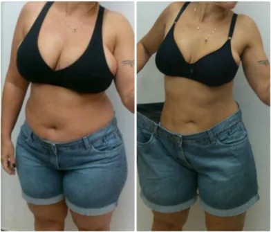 Antes e depois de aluna com redução de medidas
